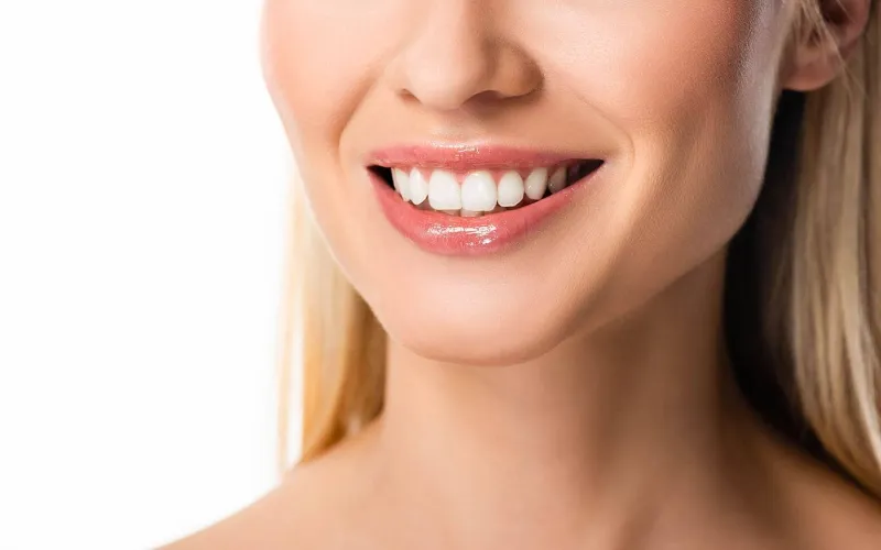 are veneers permanent