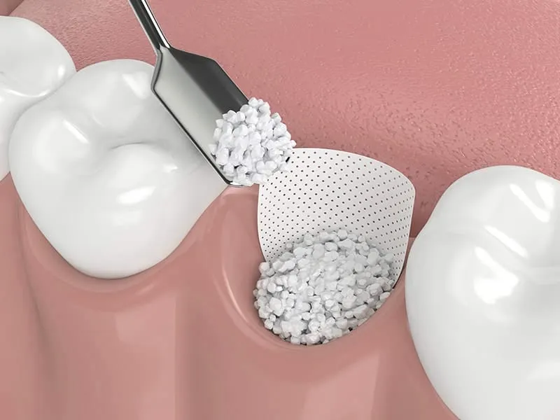 bone grafting 5