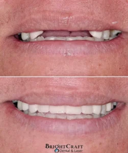 dental implants 2