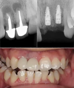 dental implants 3
