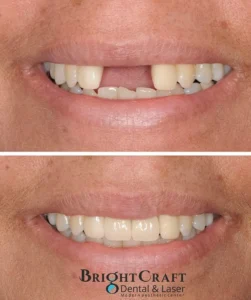 dental implants 4