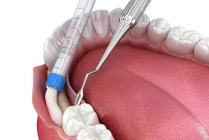 dental ridge preservation 2