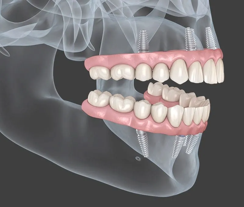 full mouth implants 2
