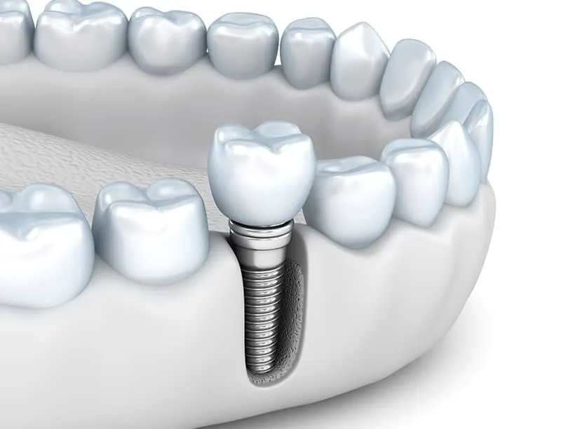 implants 3