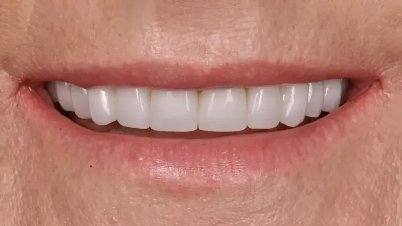 smile makeover after 2