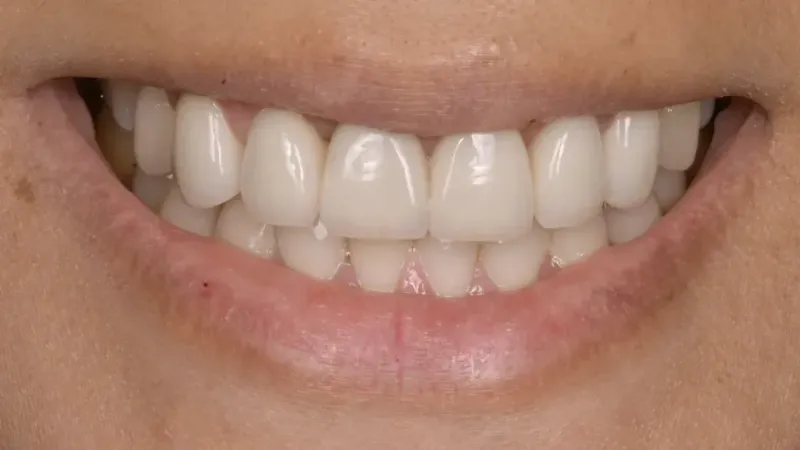 smile makeover after 3