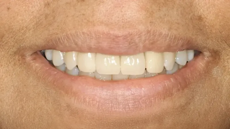 smile makeover after 8