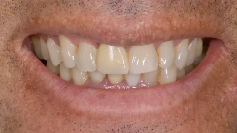 smile makeover before 5