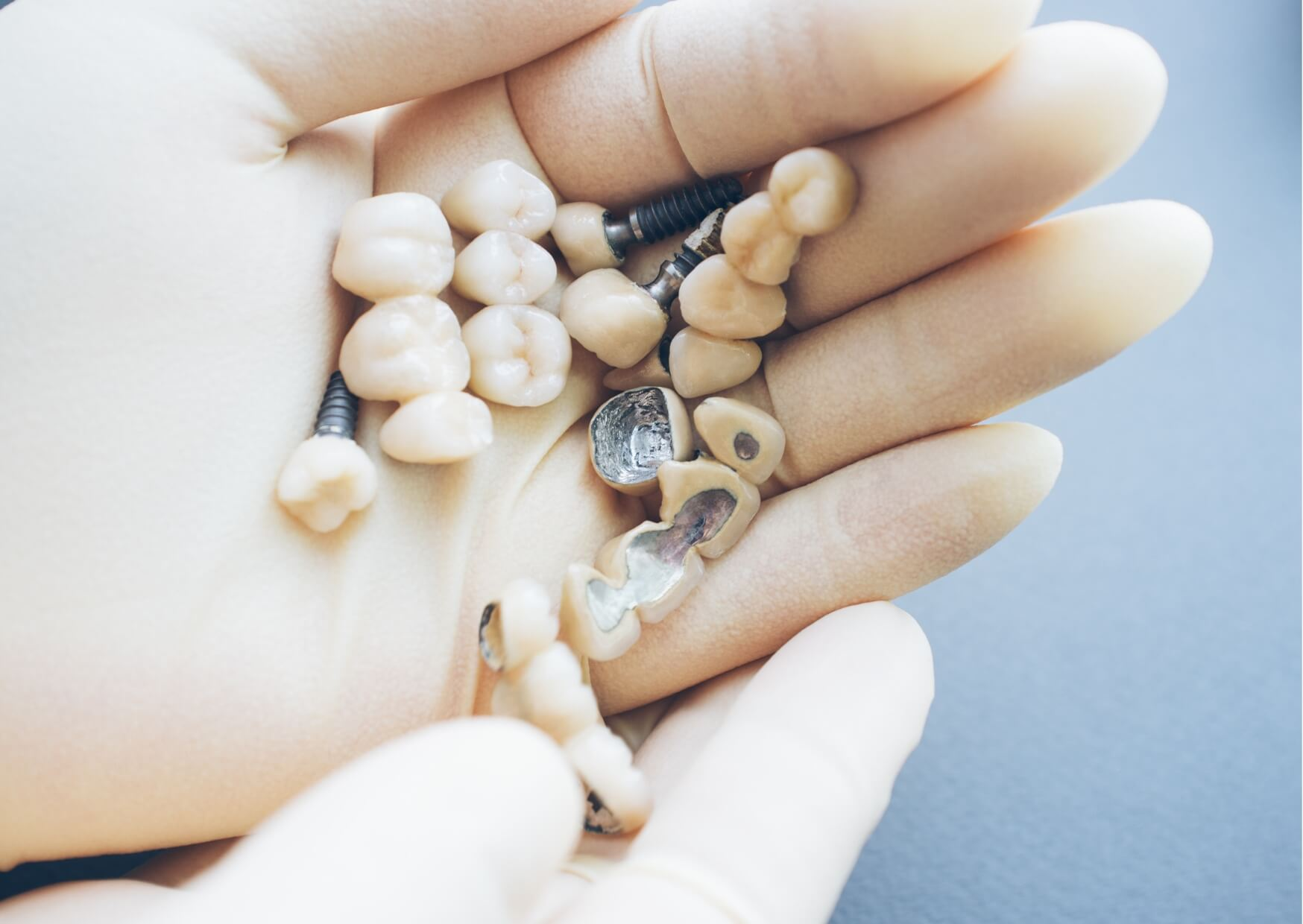 Dental restorations, including porcelain implant crowns, displayed in a gloved hand before placement during implant treatment.