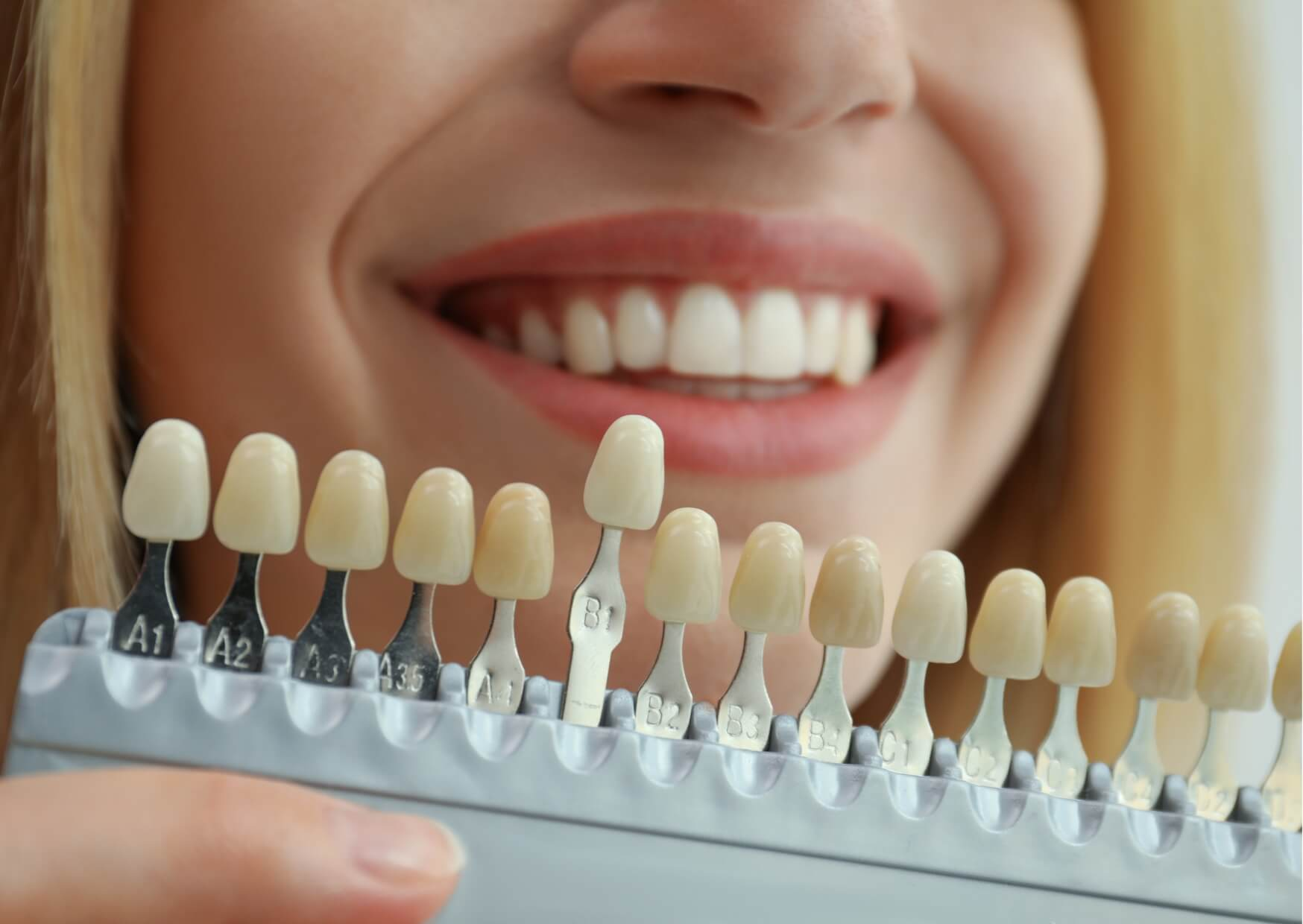 Dentist shade guide used to compare tooth color when deciding between dental bonding and porcelain veneers.