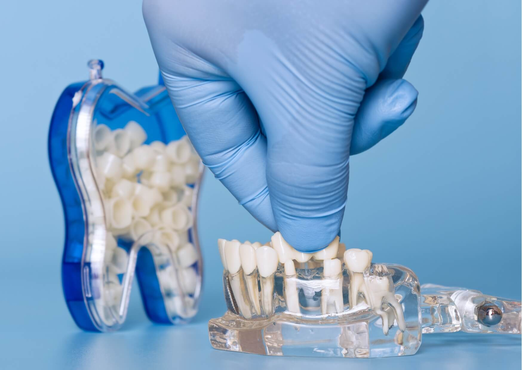 Dental model demonstrating a single tooth implant compared with a dental bridge for replacing a missing tooth.