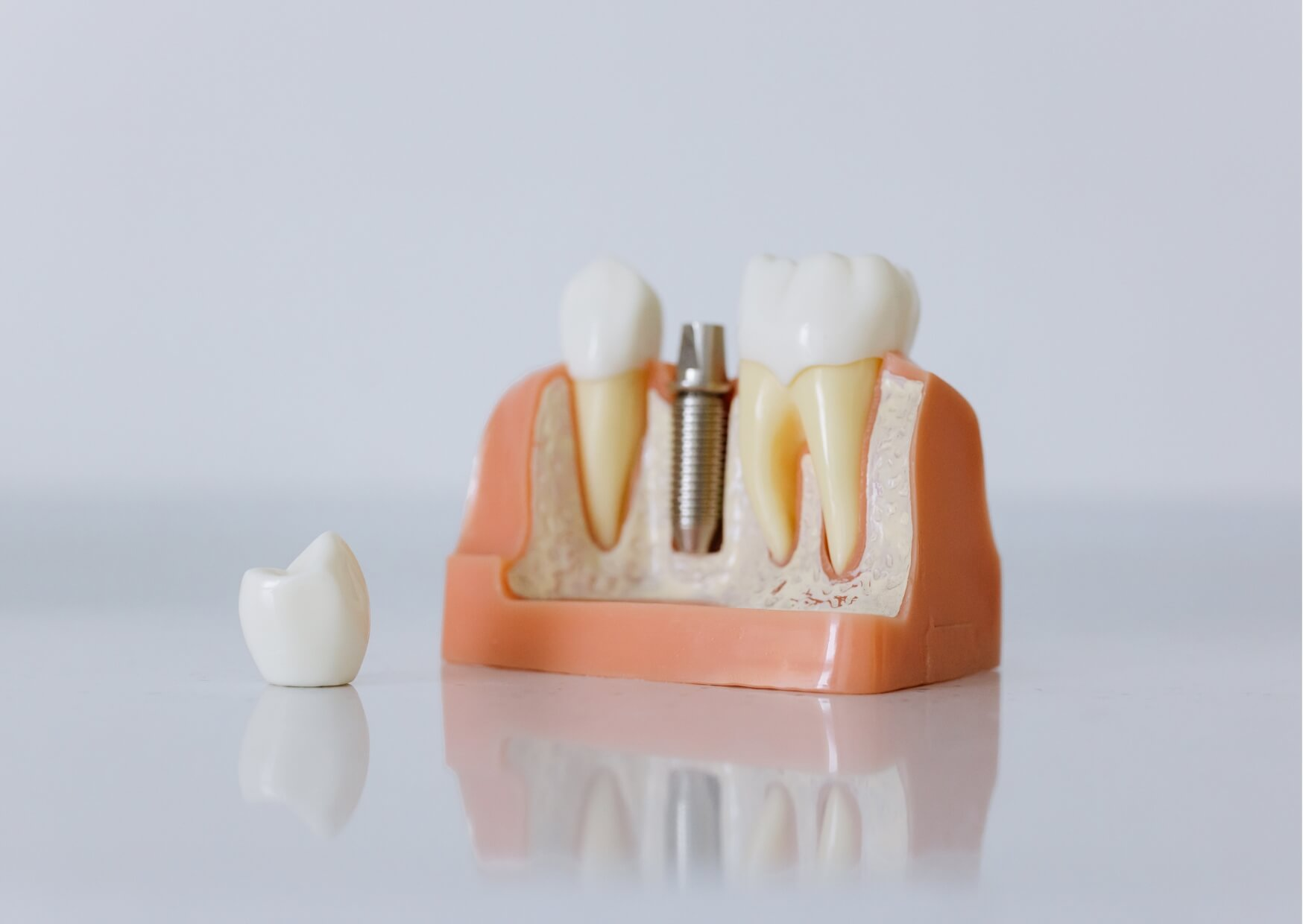 Dental implant model showing the removal of a failed implant and replacement crown during treatment planning.
