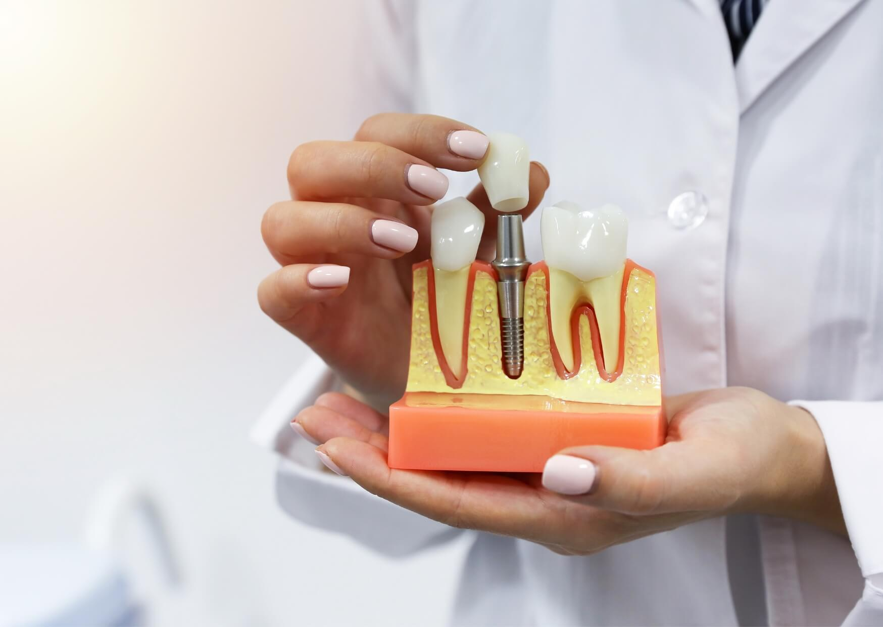 Dental implant model illustrating the implant, abutment, and crown components that influence dental implant costs.